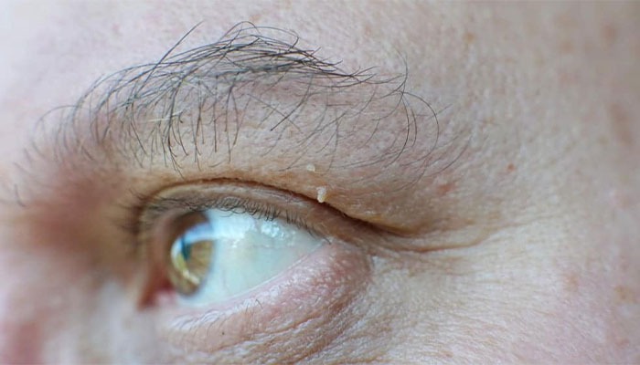 benh sui mao ga o mat 1