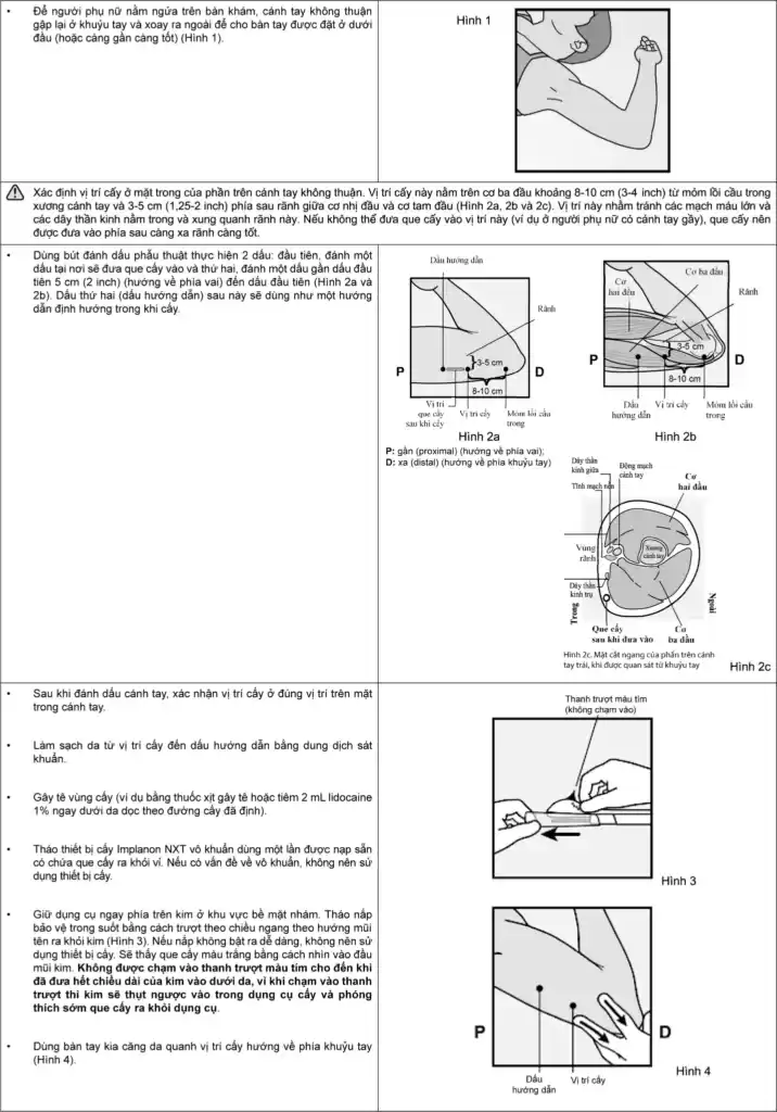 cách dùng que cấy tránh thai implanon nxt 68mg